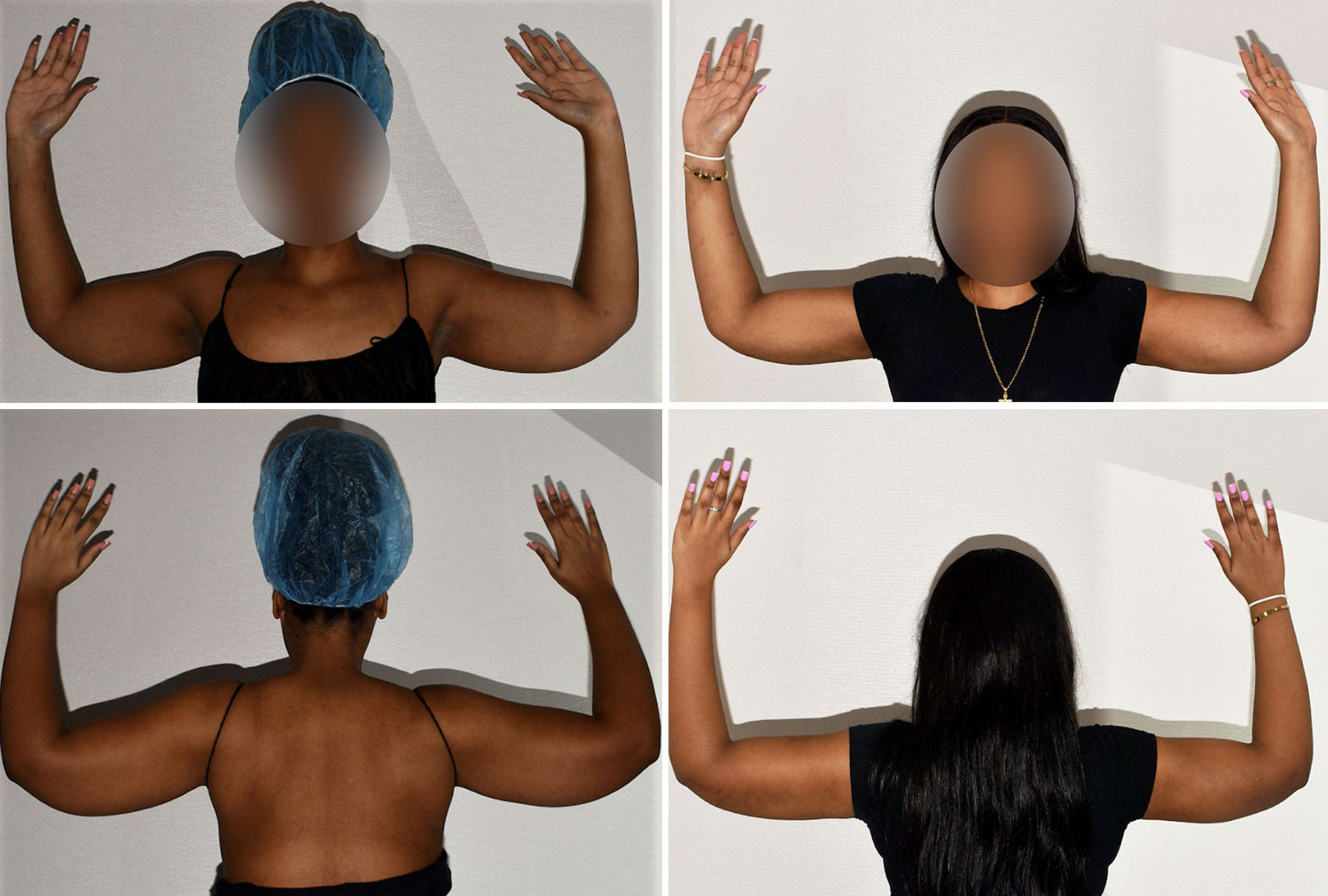 Four images showing a person from the back and front with arms raised, before and after celebrity arm liposuction, faces blurred and different hair coverings and clothing for picture-perfect arms.